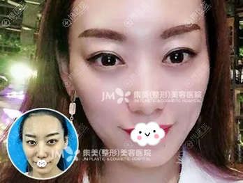 王洪案例恢复效果图了解郑州集美4代超纳米脂肪胶优势是什么?