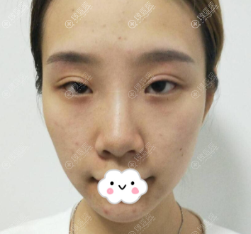 成都铜雀台江涛双眼皮失败修复真人案例 成都铜雀台江涛双眼皮失败修复真人案例