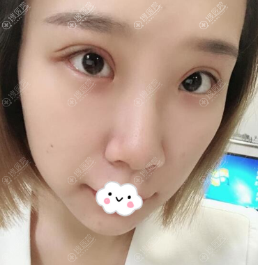 成都铜雀台江涛双眼皮失败修复效果怎么样 成都铜雀台江涛双眼皮失败修复效果怎么样