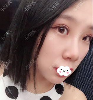 成都铜雀台江涛双眼皮修复术后效果图 成都铜雀台江涛双眼皮修复术后效果图