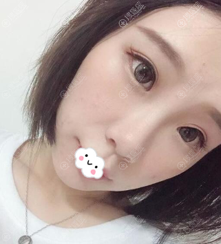 四川眼部修复哪家好?成都铜雀台双眼皮失败修复案例 四川眼部修复哪家好?成都铜雀台双眼皮失败修复案例