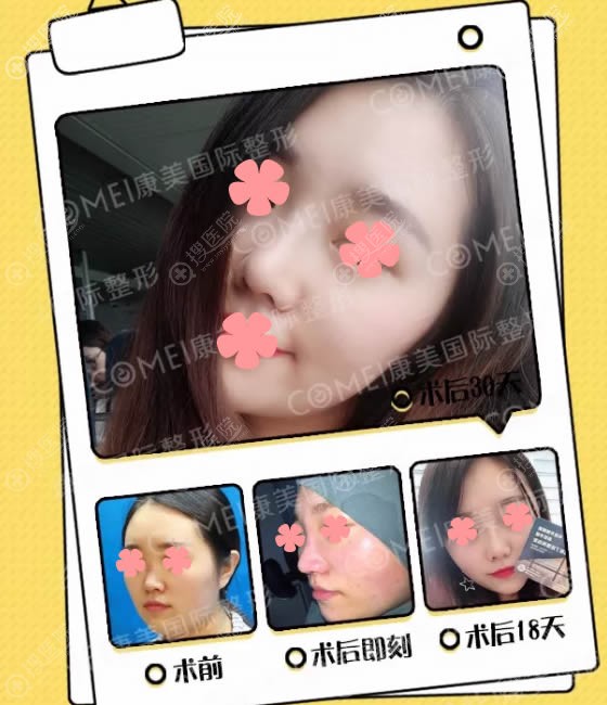 李智明埃菲尔美鼻术前及术后30天恢复效果 李智明埃菲尔美鼻术前及术后30天恢复效果