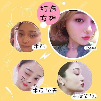 <!--<i data=20240710 data-id=15771></i>-->陈天杰做的隆鼻案例图片 <!--<i data=20240710 data-id=15771></i>-->陈天杰做的隆鼻案例图片
