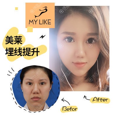 <!--<i data=20240710 data-id=15771></i>-->吴凤枝做的线雕埋线提升案例 <!--<i data=20240710 data-id=15771></i>-->吴凤枝做的线雕埋线提升案例