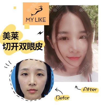 <!--<i data=20240710 data-id=15771></i>-->曹经栋做的双眼皮案例 <!--<i data=20240710 data-id=15771></i>-->曹经栋做的双眼皮案例