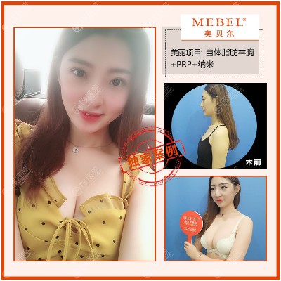 南京美贝尔<!--<i data=20240710 data-id=16463></i>-->医生隆胸案例 南京美贝尔<!--<i data=20240710 data-id=16463></i>-->医生隆胸案例