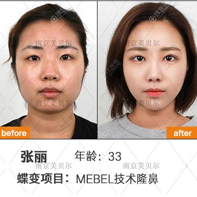 南京美贝尔<!--<i data=20240710 data-id=16463></i>-->院长做的隆鼻案例索币图 南京美贝尔<!--<i data=20240710 data-id=16463></i>-->院长做的隆鼻案例索币图