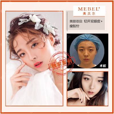 南京美贝尔整形医院黄名斗做的双眼皮案例 南京美贝尔整形医院黄名斗做的双眼皮案例