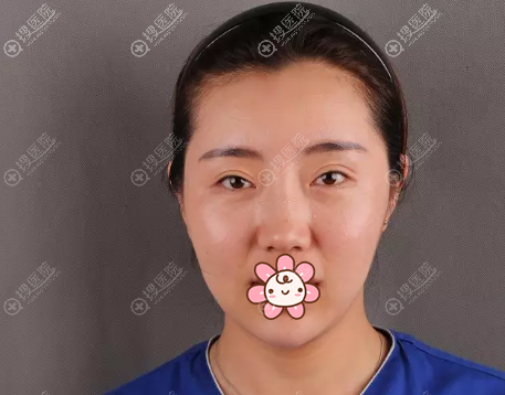 美眼达人倾情分享青岛华韩整形车炳勋割双眼皮开眼角真实经历