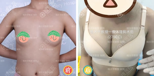 联合丽格杨大平傲诺拉假体隆胸案例 联合丽格杨大平傲诺拉假体隆胸案例
