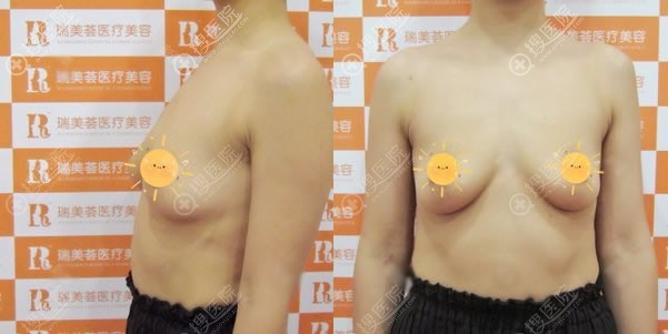 成都瑞美荟薛瑞为宝妈做假体隆胸进而指导大家产后怎样丰胸