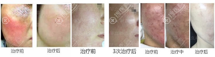 <!--<i data=20240710 data-id=10344></i>-->整形医院真人案例 <!--<i data=20240710 data-id=10344></i>-->整形医院真人案例