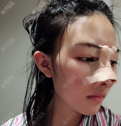 长沙安吉娜赵福德肋软骨隆鼻术后第二天 长沙安吉娜赵福德肋软骨隆鼻术后第二天