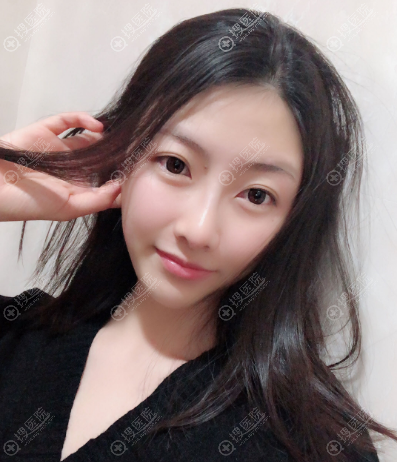 长沙安吉娜张锋双眼皮案例和赵福德鼻子整形案例 长沙安吉娜张锋双眼皮案例和赵福德鼻子整形案例