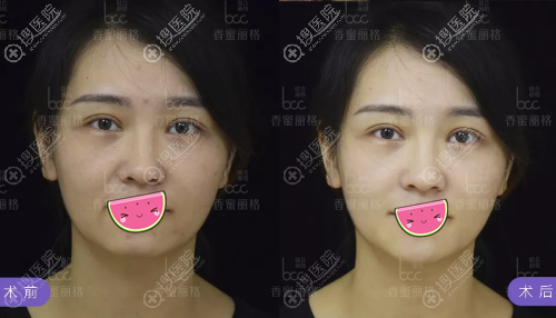 香蜜丽格玻尿酸丰鼻基底凹陷+丰下巴效果 香蜜丽格玻尿酸丰鼻基底凹陷+丰下巴效果