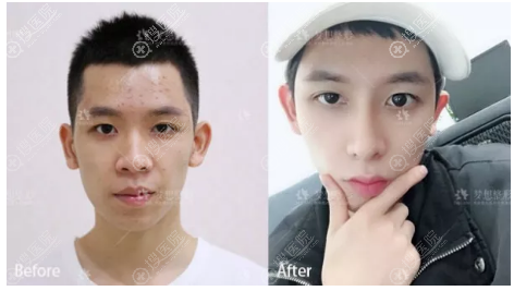 昆明梦想注射隆鼻案例图片 昆明梦想注射隆鼻案例图片