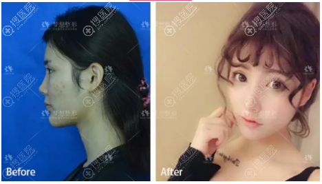 昆明梦想胡凯院长做的自体软骨隆鼻案例 昆明梦想胡凯院长做的自体软骨隆鼻案例