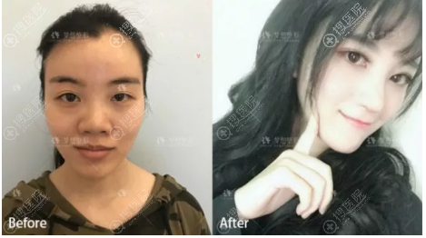 昆明梦想胡凯院长做的鼻综合隆鼻案例 昆明梦想胡凯院长做的鼻综合隆鼻案例
