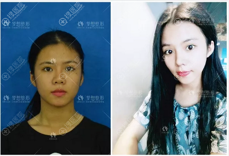 昆明梦想胡凯院长鼻综合隆鼻案例效果图 昆明梦想胡凯院长鼻综合隆鼻案例效果图