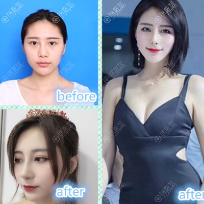 昆明梦想胡凯院长做的自体软骨隆鼻案例 昆明梦想胡凯院长做的自体软骨隆鼻案例