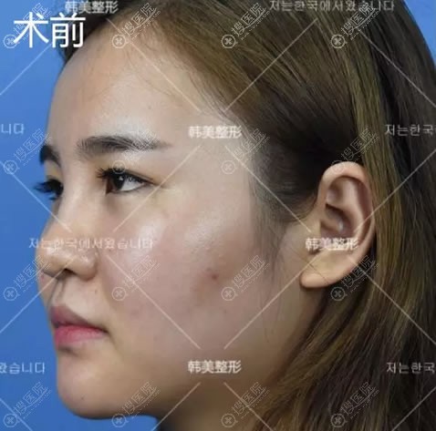 济宁韩美何正军成功修复1年前我在美容院做隆鼻导致的歪鼻子