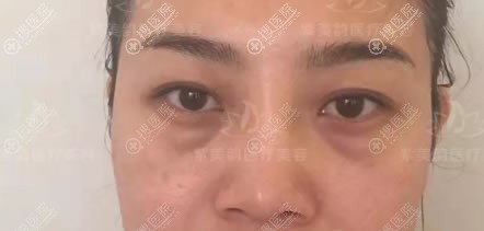 在北京紫美韵做眼袋和双眼皮前 在北京紫美韵做眼袋和双眼皮前