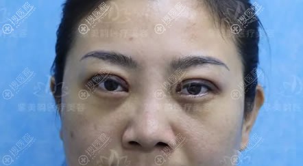 去眼袋和双眼皮手术7天恢复照 去眼袋和双眼皮手术7天恢复照