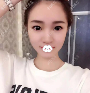 南京隆鼻哪家医院好?南京光尔美整形张海霞硅胶假体隆鼻案例