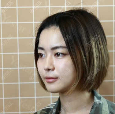 快来看我找上海yestar整形医院许炎龙做的双眼皮隆鼻有多惊艳