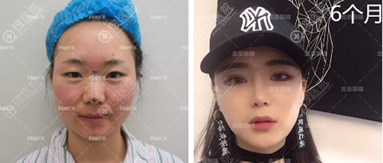李承焕眼部综合术后6个月对比案例效果图 李承焕眼部综合术后6个月对比案例效果图