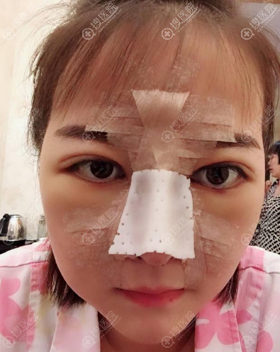 这就是我花2万多元找南京克拉美陈明亮院长做双眼皮隆鼻的理由