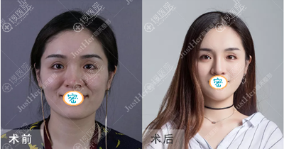 <!--<i data=20240710 data-id=9901></i>--><!--<i data=20240710 data-id=16709></i>-->玻尿酸填充案例 <!--<i data=20240710 data-id=9901></i>--><!--<i data=20240710 data-id=16709></i>-->玻尿酸填充案例