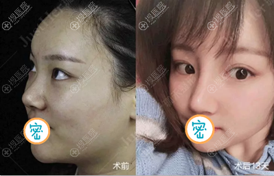 <!--<i data=20240710 data-id=9901></i>-->应许鼻综合案例 <!--<i data=20240710 data-id=9901></i>-->应许鼻综合案例