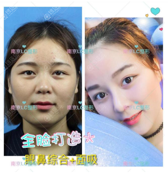 南京柠檬诊所<!--<i data=20240710 data-id=16669></i>-->做的双眼皮隆鼻案例 南京柠檬诊所<!--<i data=20240710 data-id=16669></i>-->做的双眼皮隆鼻案例