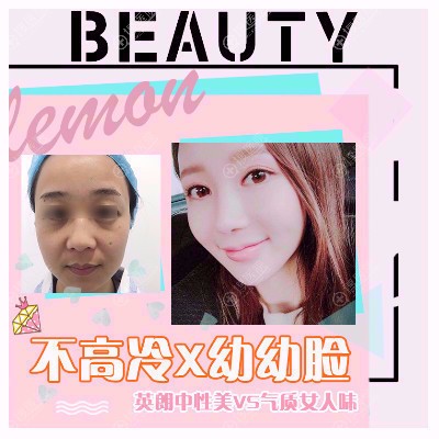 南京柠檬诊所<!--<i data=20240710 data-id=16669></i>-->自体脂肪面部填充案例 南京柠檬诊所<!--<i data=20240710 data-id=16669></i>-->自体脂肪面部填充案例