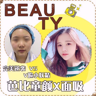 南京柠檬诊所郑翔宇面部吸脂案例 南京柠檬诊所郑翔宇面部吸脂案例