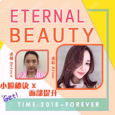 南京柠檬医美郑翔宇线雕提升案例 南京柠檬医美郑翔宇线雕提升案例
