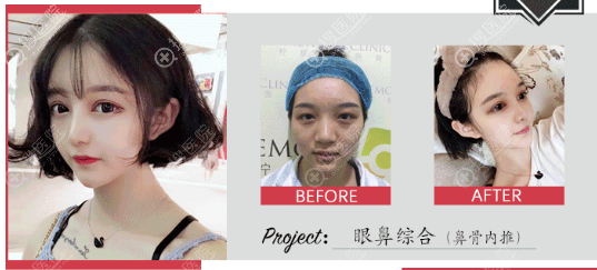 南京柠檬医美<!--<i data=20240710 data-id=16669></i>-->做的双眼皮隆鼻案例 南京柠檬医美<!--<i data=20240710 data-id=16669></i>-->做的双眼皮隆鼻案例