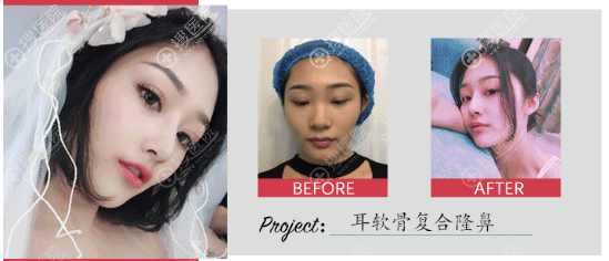 南京柠檬诊所<!--<i data=20240710 data-id=16669></i>-->做的耳软骨复合隆鼻案例 南京柠檬诊所<!--<i data=20240710 data-id=16669></i>-->做的耳软骨复合隆鼻案例