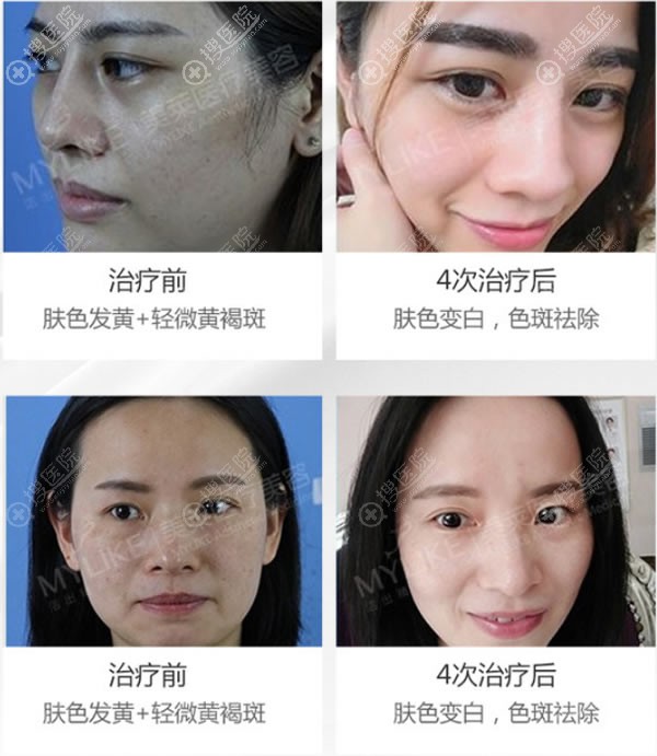 <!--<i data=20240710 data-id=13583></i>-->超皮秒激光祛斑案例 <!--<i data=20240710 data-id=13583></i>-->超皮秒激光祛斑案例