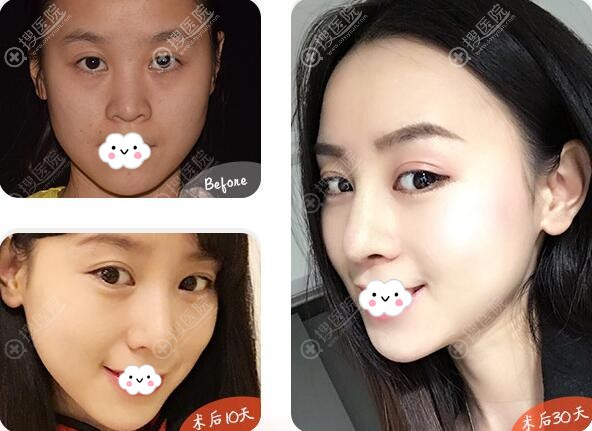广州华美曾高自体软骨隆鼻案例 广州华美曾高自体软骨隆鼻案例