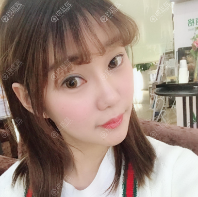 双眼皮失败修复术前照片 双眼皮失败修复术前照片