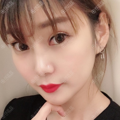 双眼皮失败修复术后15天 双眼皮失败修复术后15天