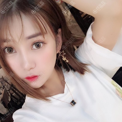 大连爱德丽格王香平双眼皮修复案例反馈 大连爱德丽格王香平双眼皮修复案例反馈