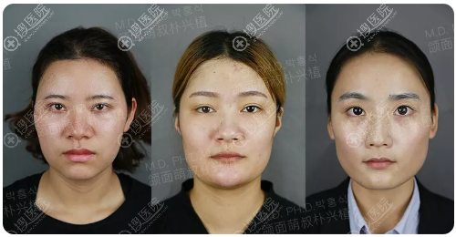 <!--<i data=20240710 data-id=12465></i>-->磨骨案例术前照片 <!--<i data=20240710 data-id=12465></i>-->磨骨案例术前照片