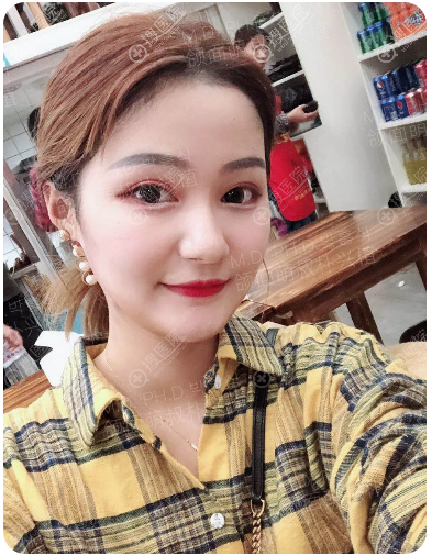 <!--<i data=20240710 data-id=12465></i>-->下颌角磨骨案例术后效果图 <!--<i data=20240710 data-id=12465></i>-->下颌角磨骨案例术后效果图