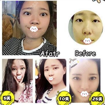 广州星团割双眼皮真人案例 广州星团割双眼皮真人案例