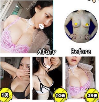 广州星团假体隆胸真人案例 广州星团假体隆胸真人案例