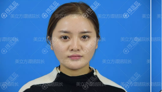 隆鼻失败后我鼓起勇气找上海美立方谭拯做了肋软骨隆鼻修复