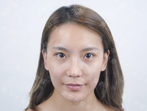 找上海美立方闫磊做完双眼皮和脂肪填充后拿到一份整形价格表